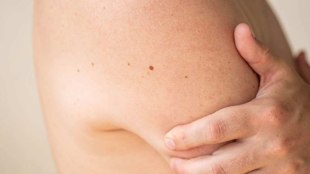 Map My Mole at Bradford Skin Clinic